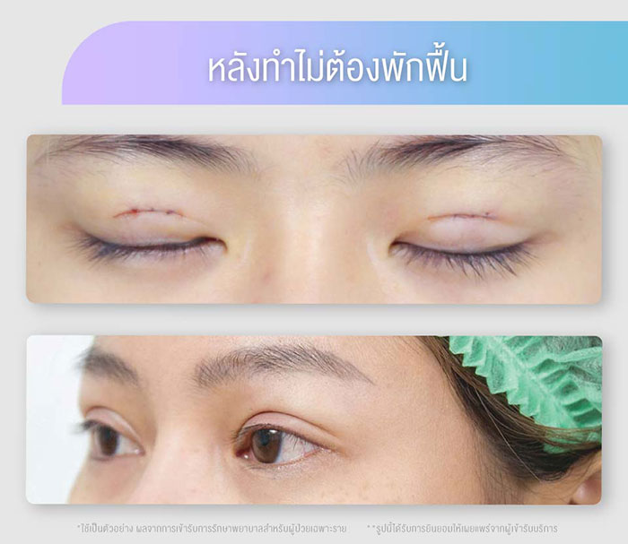 double-eyelid-surgery3