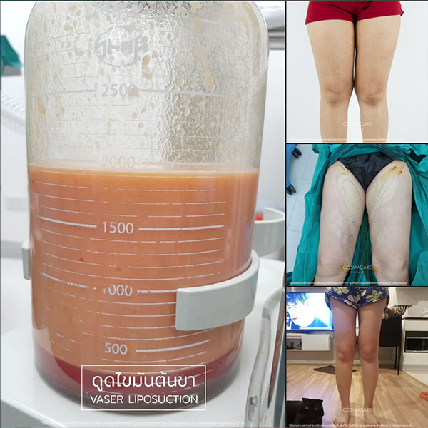 review-liposuction-29may2023