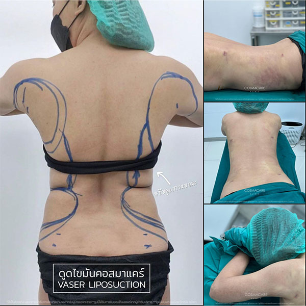 review-liposuction-back-4sep22