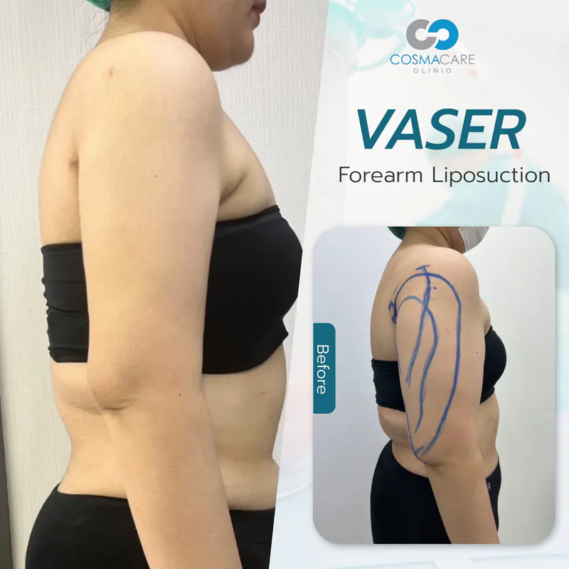 162_vaser_Eng-01_liposuction-vaser-bangkok_ดูดไขมัน