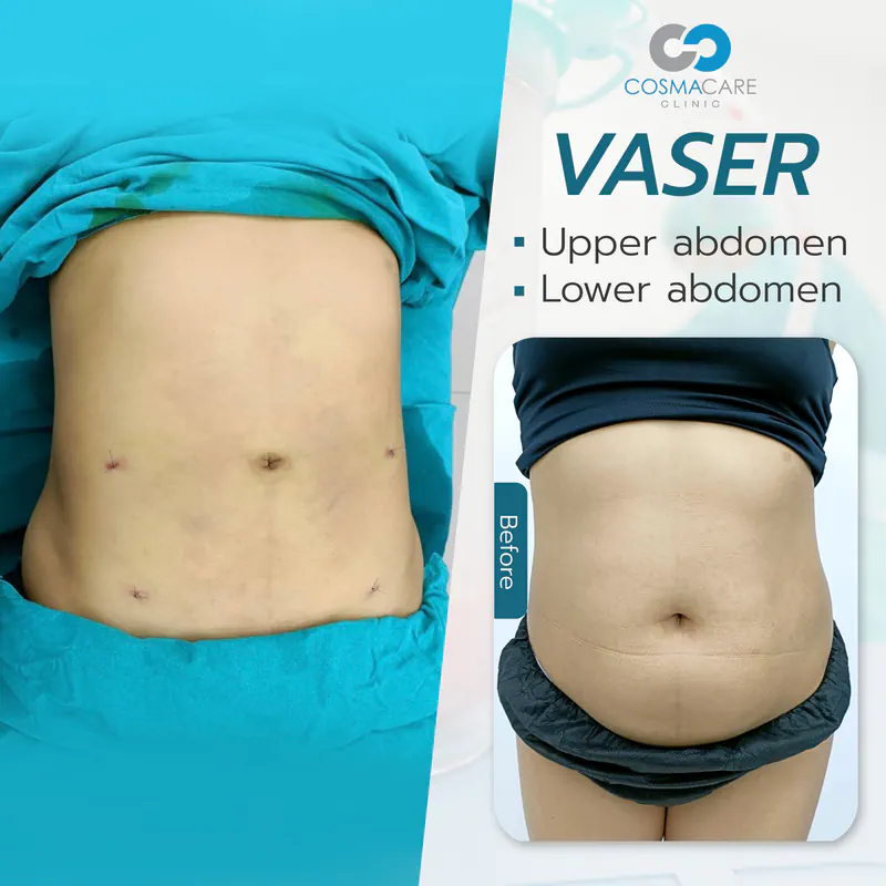 162_vaser_Eng-02_liposuction-vaser-bangkok_ดูดไขมัน