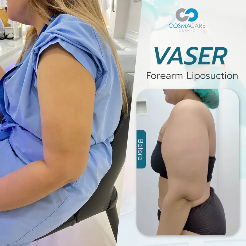 162_vaser_Eng-03_liposuction-vaser-bangkok_ดูดไขมัน
