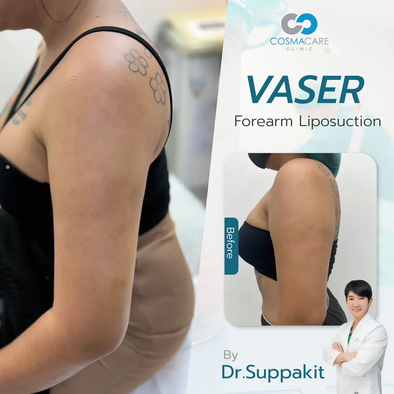 162_vaser_Eng-04_liposuction-vaser-bangkok_ดูดไขมัน