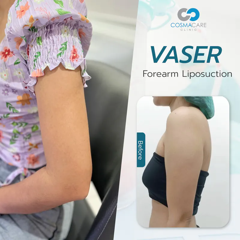 162_vaser_Eng-05_liposuction-vaser-bangkok_ดูดไขมัน