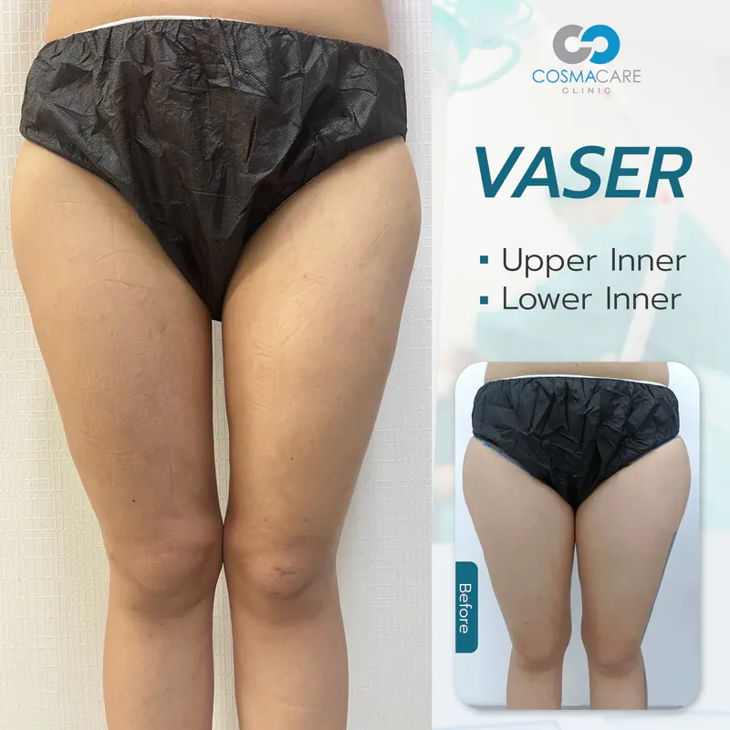 162_vaser_Eng-06_liposuction-vaser-bangkok_ดูดไขมัน