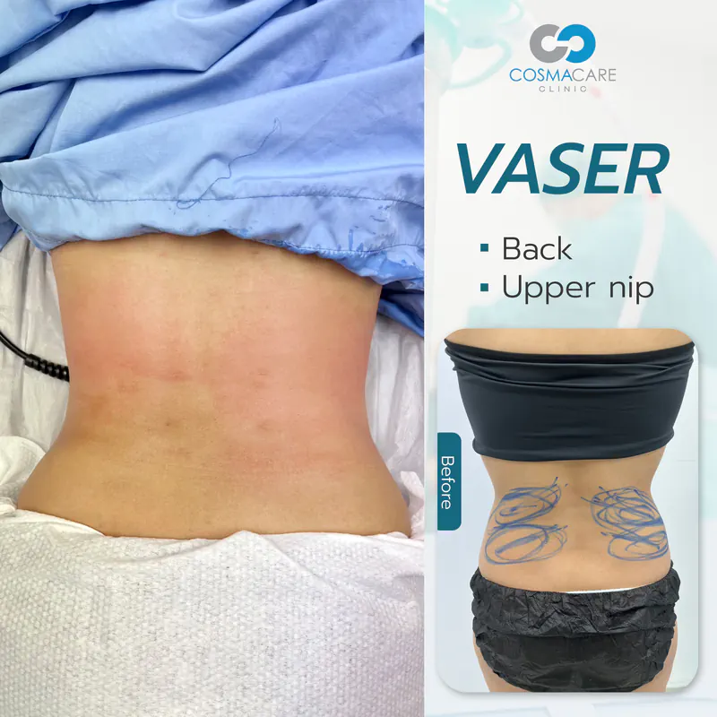 162_vaser_Eng-07_liposuction-vaser-bangkok_ดูดไขมัน