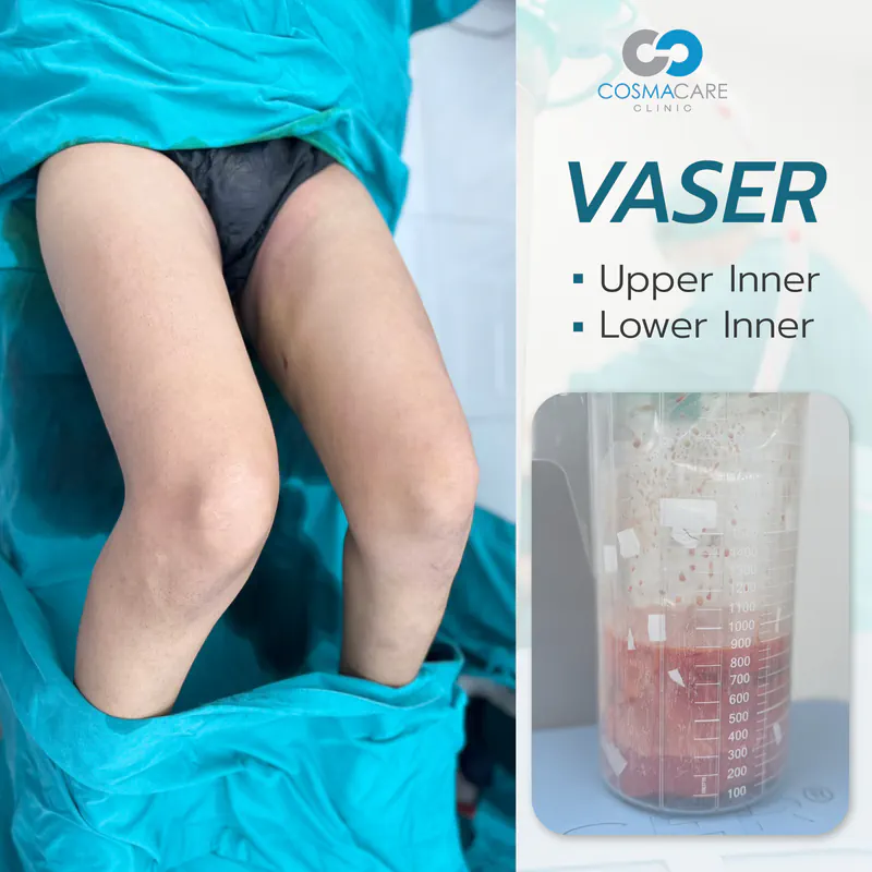 162_vaser_Eng-08_liposuction-vaser-bangkok_ดูดไขมัน