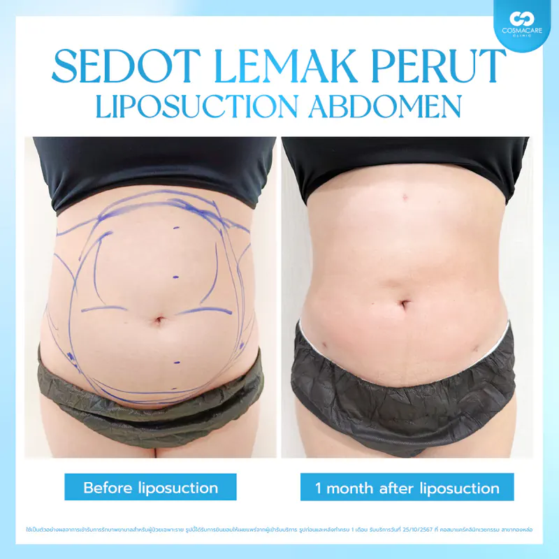 Artboard 4 copy 3(1)_liposuction-vaser-bangkok_ดูดไขมัน