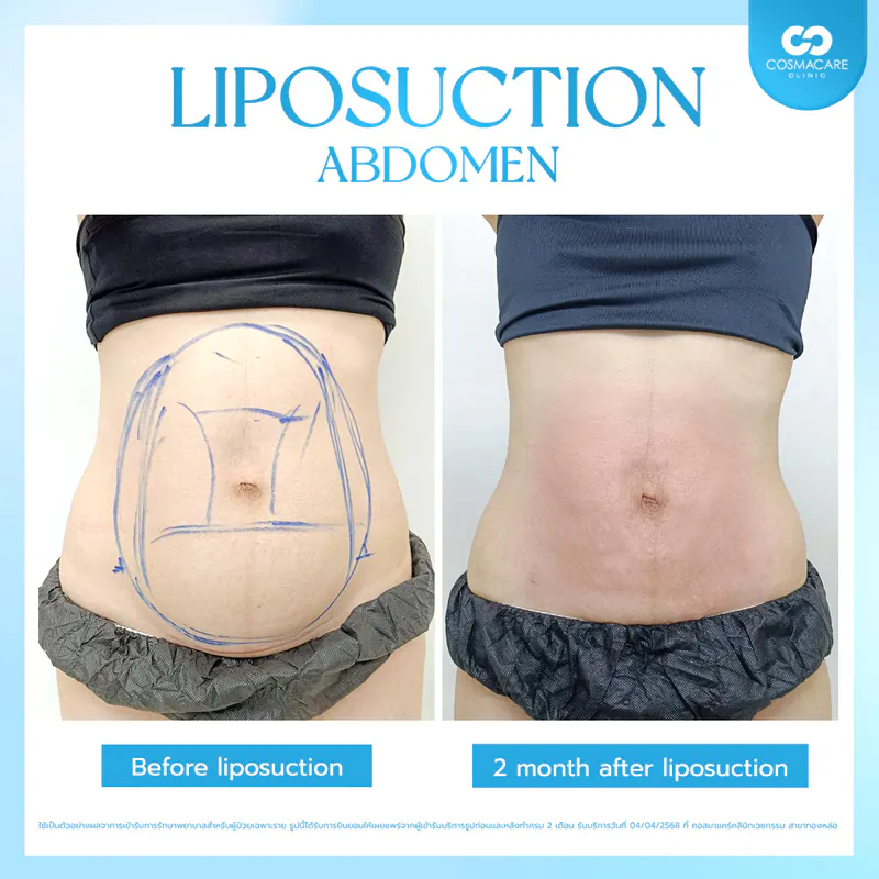 Artboard 4 copy 4_0_liposuction-vaser-bangkok_ดูดไขมัน