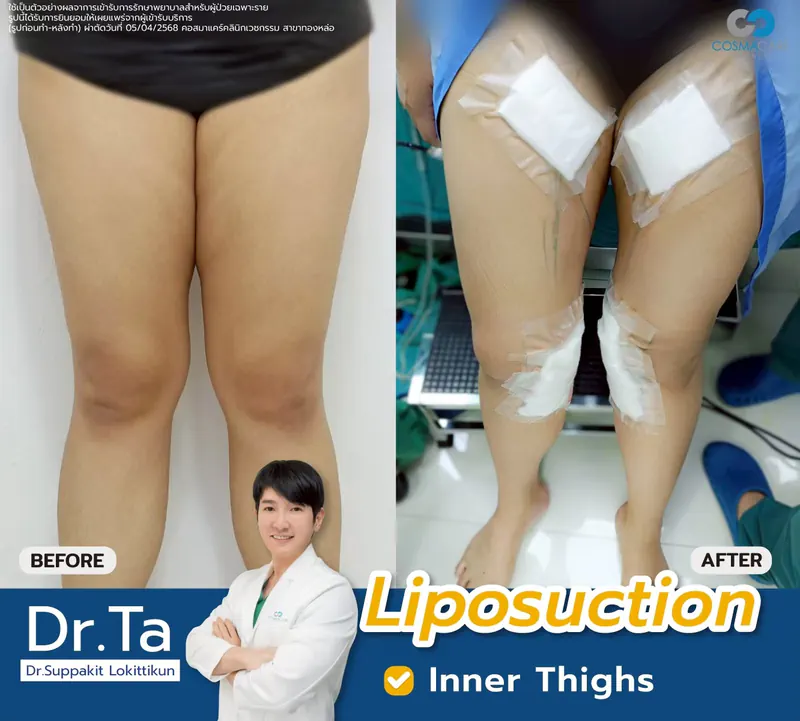 LINE_ALBUM_2025.8.7 _1_251120_7_liposuction-vaser-bangkok_ดูดไขมัน