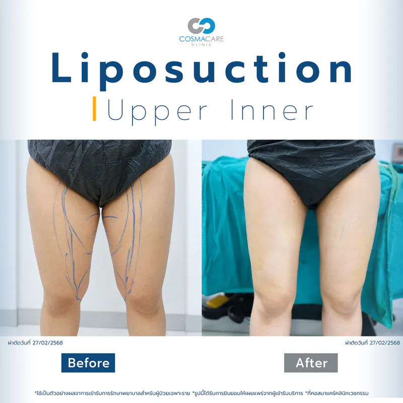 Lipo_19-05-04_liposuction-vaser-bangkok_ดูดไขมัน