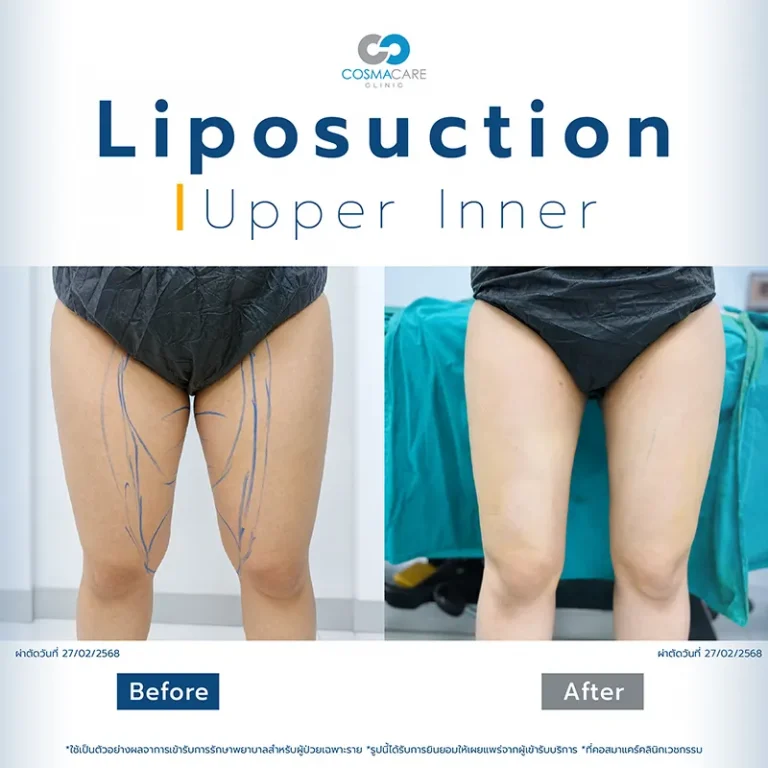 Lipo_19-05-04