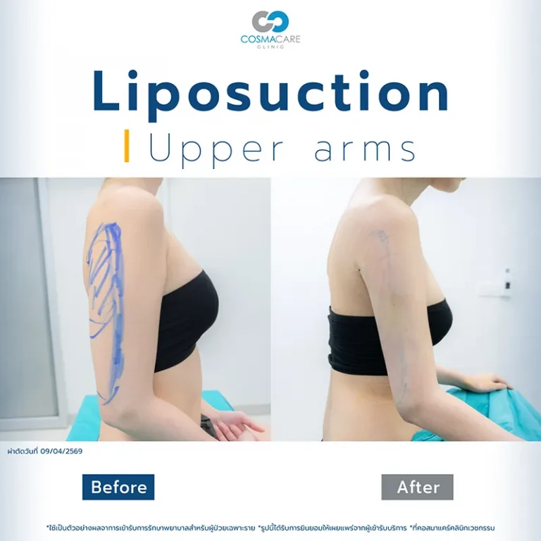 Lipo_Before-After_Set1-12