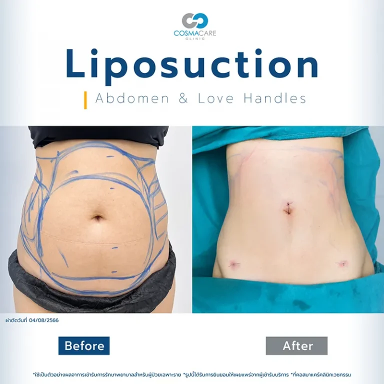 Lipo_Set3-11